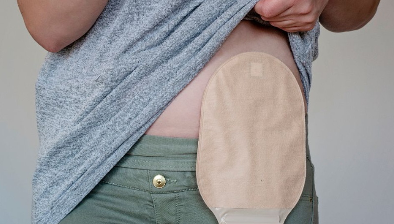 patient wearing ostomy bag